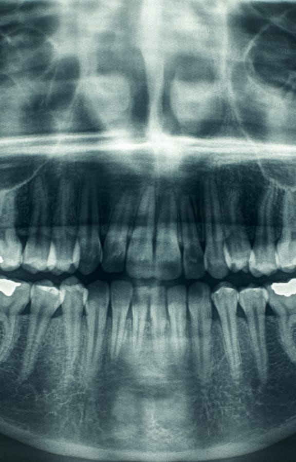 Panoramic X-Ray of teeth